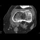 Lipohemarthros, fracture of knee, depression fracture of tibial plateau: CT - Computed tomography
